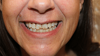 Closeup of older man's smile before cosmetic dentistry treatment