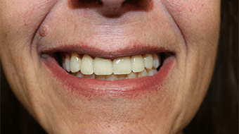 Closeup of older man's flawless smile after cosmetic dentistry