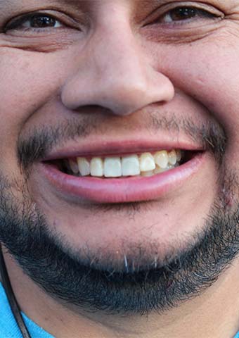 Older man with damaged and yellowed smile before cosmetic dentistry