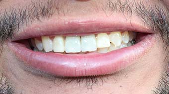 Closeup of older man's smile before cosmetic dentistry treatment