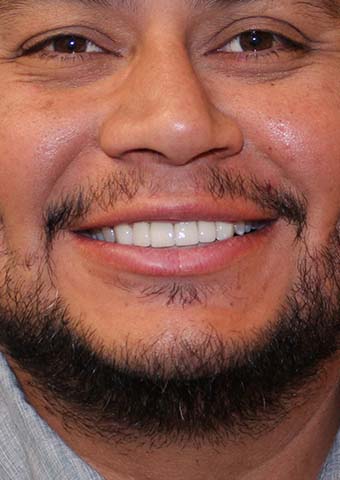 Older man's flawless smile after cosmetic dentistry