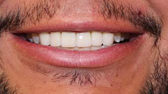 Closeup of older man's flawless smile after cosmetic dentistry