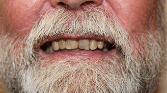 Closeup of older man's smile before cosmetic dentistry treatment