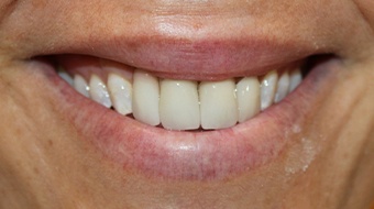 Closeup of older man's flawless smile after cosmetic dentistry