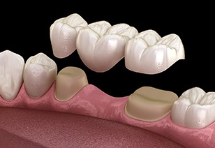 an example of a traditional dental bridge in New Braunfels