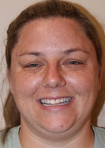 Woman with yellowed smile before cosmetic dentistry