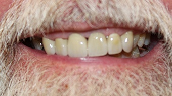 Closeup of older man's flawless smile after cosmetic dentistry