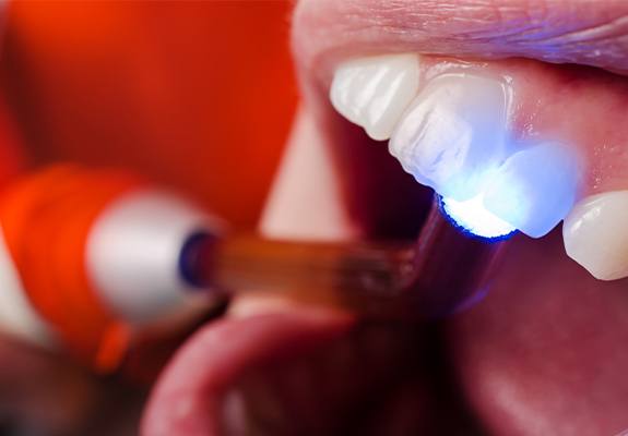 Patient receiving dental bonding treatment