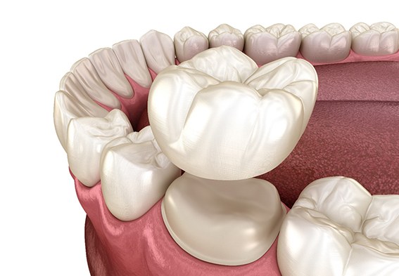 Illustration of a dental crown being placed on a tooth