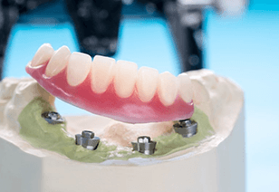 an example of implant dentures in New Braunfels