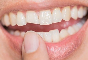 Closeup of smile with chipped front tooth