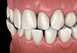Illustration of a crossbite