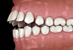 Illustration of an open bite