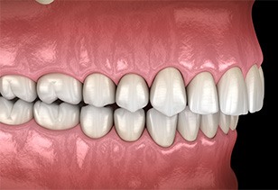 Illustration of an overbite
