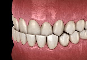 Illustration of an underbite