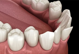 Illustration of crowded teeth