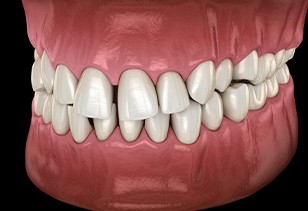 Illustration of gapped teeth