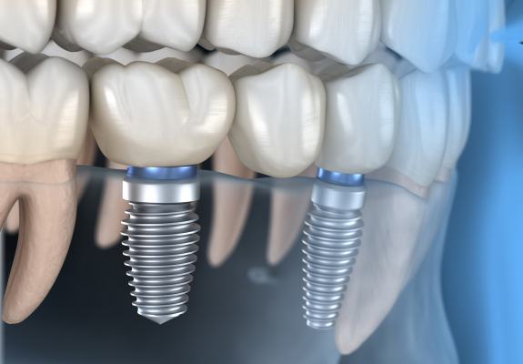 Animated implant supported fixed bridge