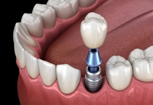 Animated implant supported dental crown placement