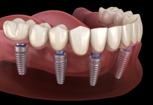 Animated implant supported denture placement