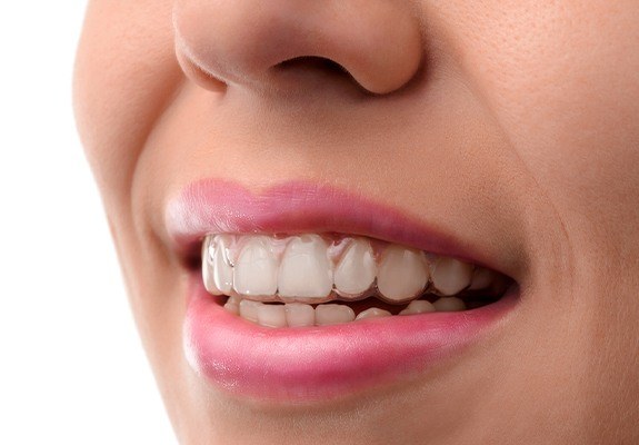 Closeup of smile with Invisalign tray in place