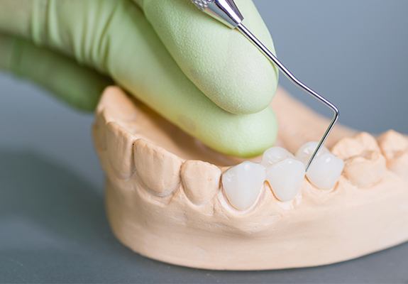 Model smile with fixed bridge restoration