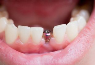 patient smiling with implant in mouth 