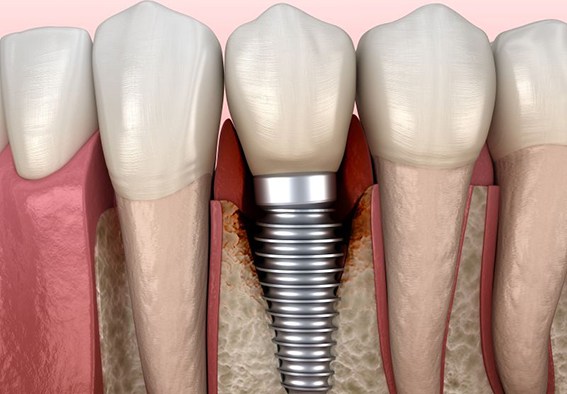 Illustration of infected tissue around a dental implant