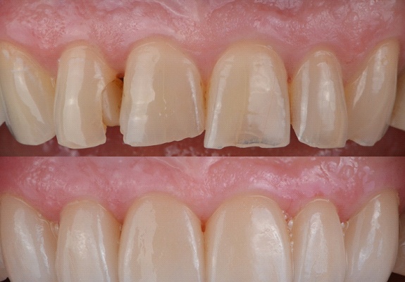 A before image of broken and worn teeth followed by an after image of the same smile only with customized veneers