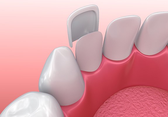 Diagram of how veneers in New Braunfels are placed