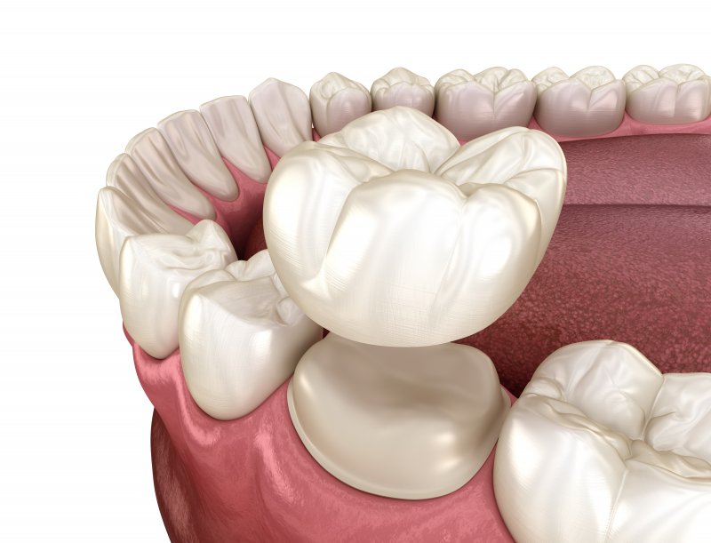 example of a dental crown in New Braunfels