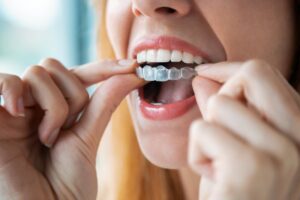 Woman fitting Invisalign onto teeth.