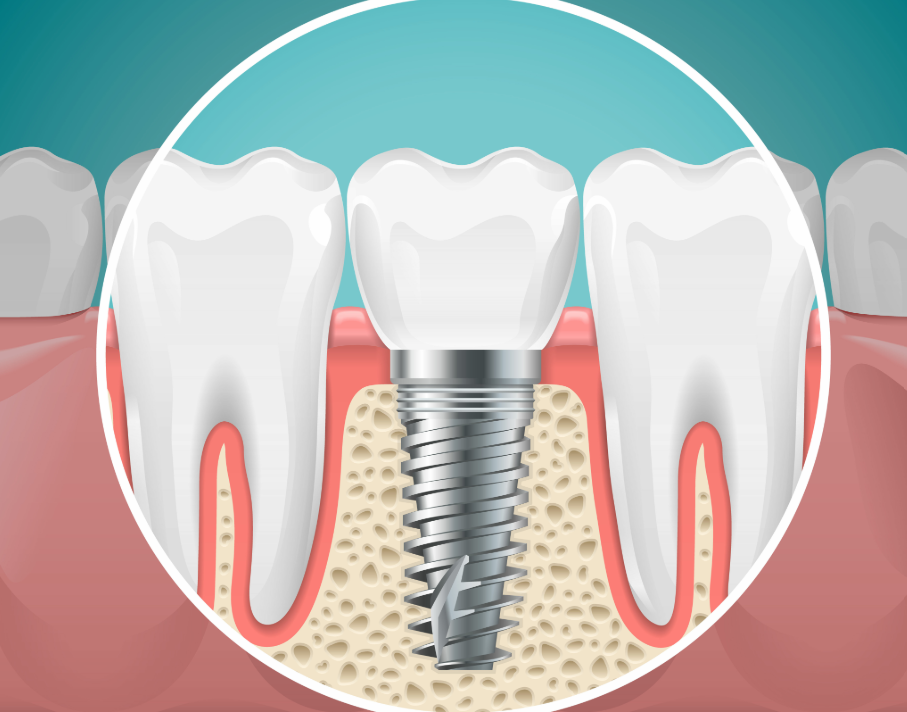 Illustrated cross section of a dental implant